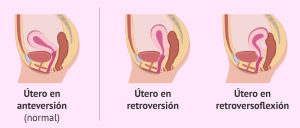 utero-retroverso-y-normal